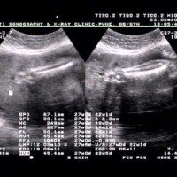 My Anomaly Scan Video